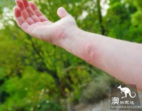太毒了！澳洲男修剪草坪时，突然浑身肿胀命丧黄泉！我们后院里竟暗藏澳洲第一杀手！