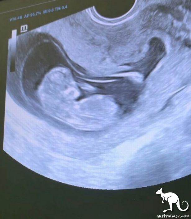 玛丽娜分享了婴儿的超声影像