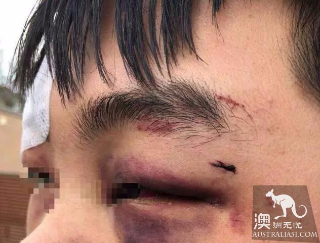 突发！中国留学生遭本地人暴力围殴致浑身是血，因拒绝给烟