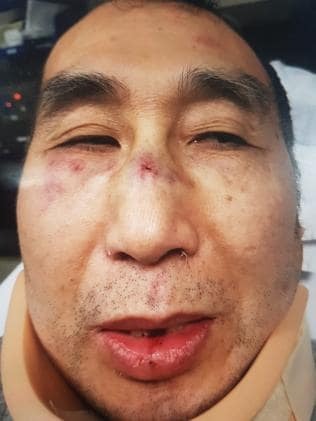 又有澳洲华裔店主遭持械抢劫，枪托砸头伤口骇人！华人商家成目标？每月一伤！