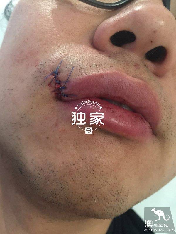 “他们叫嚣捅死我们、强奸我,还想烧店!”卧龙岗华人及留学生成袭击目标,频遭殴抢,多人受伤!